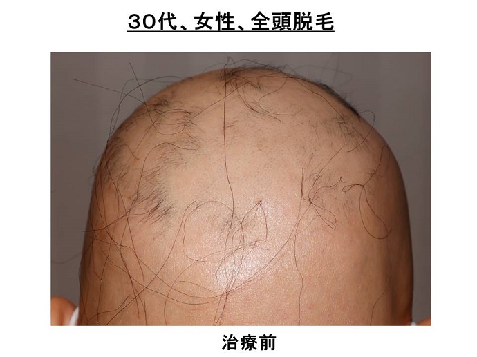 円形脱毛症　病院